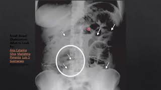 Intestino delgado V Isquemia mesentérica [upl. by Fai]