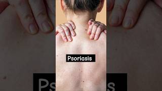 What is Psoriasis psoriasis skin acne [upl. by Dorn]