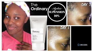 7 DAYS USING ORDINARY AZELAIC ACID SUSPENSION 10 FOR ACNE HYPERPIGMENTATION INFLAMMATION ROSACEA [upl. by Grindle]