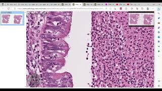 bronchopneumonia شريحة باثولوجي [upl. by Furie]