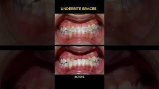 Braces process  Underbite [upl. by Molini]