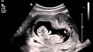 Jumping womb dancer baby ultrasound scan [upl. by Mycah]