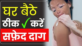 Home Remedies for Vitiligo  Safed Daag ka Ilaaj in Hindi  Gharelu Upay [upl. by Duncan266]