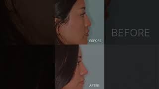 Creating a gentle slope  Anthony Bared MD FACS  Miami FL [upl. by Flosi]