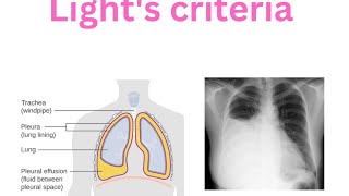 Pleura  Pleural effusion  Lights criteria  Transudate  Exudate Empyema [upl. by Sherwin]