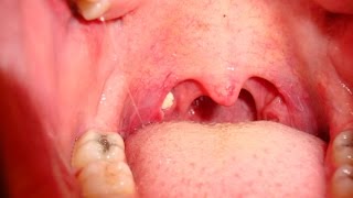 Tonsil Stones  How to Remove Tonsil Stones [upl. by Hafirahs]