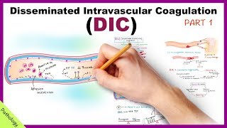 DIC Disseminated Intravascular Coagulation  Part 1 [upl. by Smailliw]