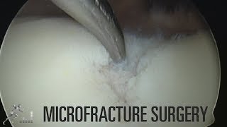 Cartilage injury and surgery Microfracture [upl. by Akitahs424]