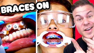 How Braces Are Put On  Watch Before You Get Braces [upl. by Thais]