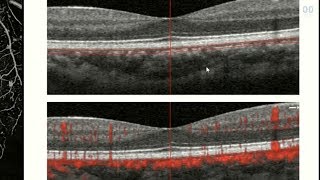 OCT Angiography Revolutionizing Vitreoretinal Disease [upl. by Steffane3]