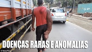 DOENÇAS RARAS E ANOMALIAS 18 IMAGENS FORTES [upl. by Strohben794]