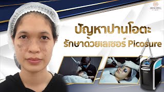 🚩ปัญหาปานโอตะ รักษาด้วยเลเซอร์ Picosure [upl. by Laefar]