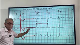 VENTRICULAR ECTOPICS  VENTRICULAR PREMATURE BEATS HOW TO DIAGNOSE ON ECG [upl. by Virgie]