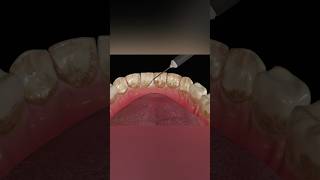 Dental Scaling Procedure medicalanimation health shorts [upl. by Gerry]