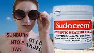 THE SUDOCREM EXPERIMENT  How to get rid of sunburn FAST  also UPDATE Face Mask Video [upl. by Anait]