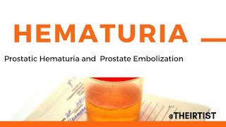 Prostate Hematuria  Blood in urine and PAE  prostate artery embolization [upl. by Allix572]