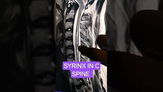 syrinx c spine mri [upl. by Aninay602]