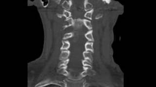 Radiology Rounds CT Cervical Spine  Dens Fracture [upl. by Nylrahs798]