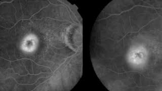 FFA CLASSIFICATION OF CNVM Choroidal neovascular membrane  Occult vs Classic CNVM [upl. by Coh973]