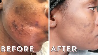 Clearing My Hormonal Acne With Spironolactone  Skin Update 3 [upl. by Latisha706]