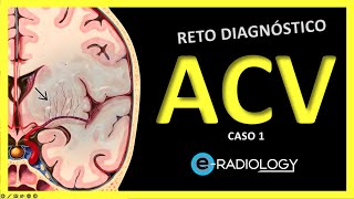 ECV 🧠  Caso 1  Enfermedad CEREBROVASCULAR  Explicación de SIGNOS RADIOLÓGICOS  Isquemia CEREBRAL [upl. by Ehttam]