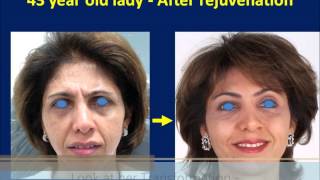 Botox amp Dermal Filler Injection Made Her Young Again  Liquid Facelift Technique [upl. by Gabie]