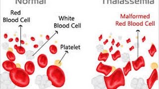 Thalassemia [upl. by Enomes]