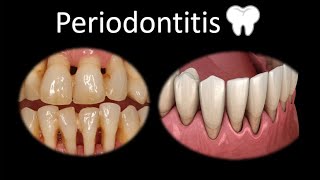 🦷 Periodontitis  Cavidad oral  Cabeza y Cuello  Patología [upl. by Christen]