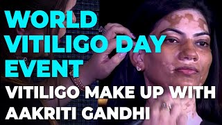 How to cover vitiligo patchesDr Nitika Kohlivitiligo makeup [upl. by Darrill]