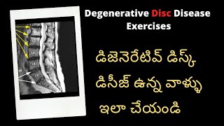 Disc Degeneration Disease DDD Treatment for Degenerative Disc Disease Lumbar Disc L4L5 L5S1 [upl. by Bonney]