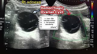 Hemorrhagic Ovarian Cyst [upl. by Garwin]