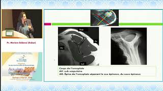 IRM de lépaule pour le rhumatologue Pr Meriem Edderai [upl. by Licht]