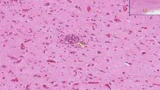 Histopathology Brain Viral encephalitis [upl. by Lorrac715]