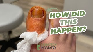 Partial TOENAIL Removal [upl. by Mae365]