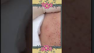 Daily acne removal [upl. by Akinit]