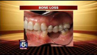 Coping with Tooth Loss [upl. by Atival]