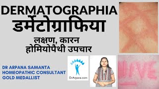 डर्मेटोग्राफिया हाइव्स लक्षण उपचार और कारण  DERMATOGRAPHIA Urticaria amp Homeopathic Treatment [upl. by Nayek]