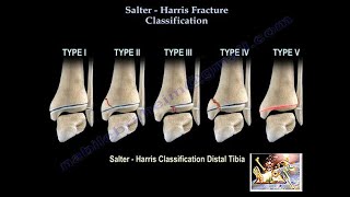 Salter Harris Fracture Classification  Everything You Need To Know  Dr Nabil Ebraheim [upl. by Ravo895]