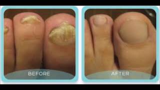 How Long Should I Take Lamisil For Toenail Fungus  Quickest Way To Remove Toenail Fungus [upl. by Derina]