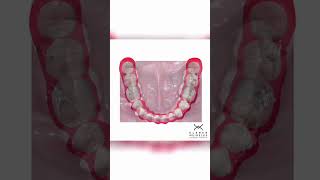 ORTHODONTIC SPACE CLOSURE  ORTHODONTIC TIPS Shorts [upl. by Ahsac]