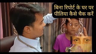 Jaundice How To Check Jaundice At Home Without Any Report पीलिया जौन्डिश के लक्षण [upl. by Annirak]