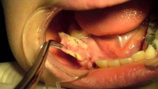 Dentigerous Cyst Marsupialization [upl. by Ordnasil529]