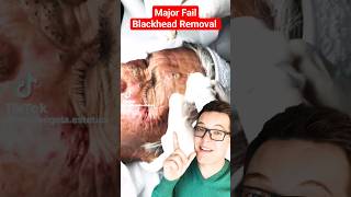 OMG Worst BLACKHEAD REMOVAL 2024  Fail shorts [upl. by Nirrak321]