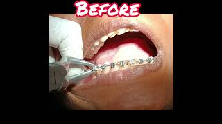 Orthodontic Treatment for Spacing dentist dentalclinic doctor orthodontist smilemakeover [upl. by Milly]