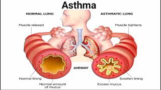 normal lung vs asthmetic lung  asthma symptoms  biology class 9 by Last moment tuitions [upl. by Tine]