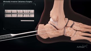 Minimally Invasive Calcaneus Surgery [upl. by Ramoh399]