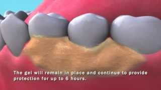 PerioPatch Topical Patch for Gingival Repair [upl. by Vento]