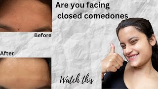 How to treat closed comedonesTiny Bumps on Forehead😱in 3weeks [upl. by Aicilana17]