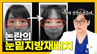 눈밑지방재배치 해야 하는 이유  눈밑지방재배치 vs 하안검  나이가 젊었을때 눈밑지방재배치해도 되나요  눈밑지방재배치 수술시간  눈밑지방재배치 부작용  성하민 원장 [upl. by Eedahs407]