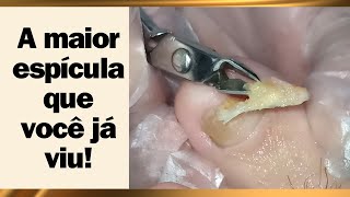 A MAIOR ESPÍCULA QUE VOCÊ JÁ VIU viral satisfying unha encravada gigante [upl. by Moe58]